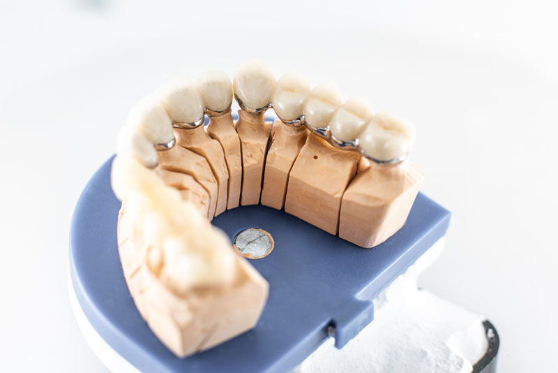 Dental Crowns Galway