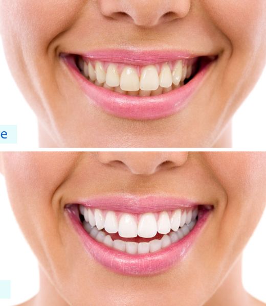 Teeth Whitening Galway